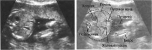 Увеличена печень у плода 13 недель беременности
