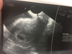 Снимок узи 5 недель