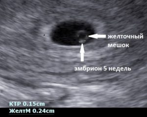 На 5 неделе не видно эмбриона