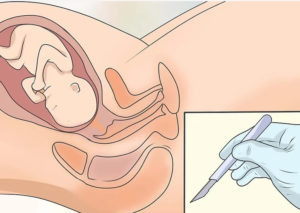 Стимуляция родов гелем на 41 неделе отзывы