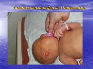 Нарушение сосательного рефлекса у новорожденного