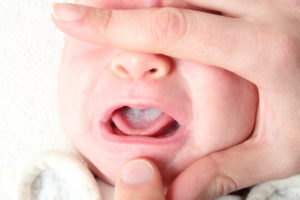 Как молочница проявляется у новорожденных?