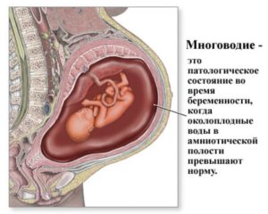 Умеренное многоводие при беременности 32 недели