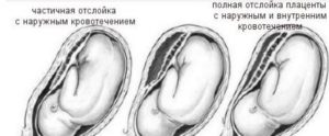 Отслойка плаценты на 9 10 неделе беременности