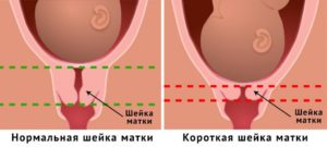 Короткая шейка матки 23 недели