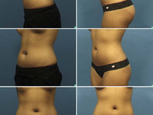 Ультразвуковая кавитация побочные эффекты