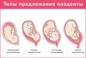 Низкое расположение плаценты при беременности 12 недель