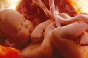 Однократное обвитие пуповиной на 33 неделе беременности