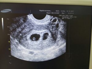 Узи после эко на 3 недели