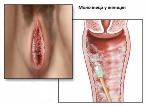 Молочница 10 неделе беременности лечение