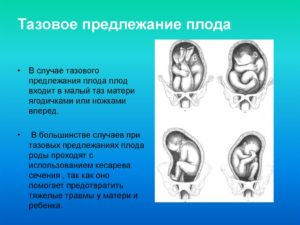 40 Недель беременности тазовое предлежание