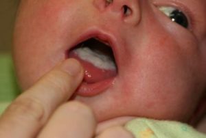 Молочница симптомы у детей во рту