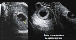 Киста желтого тела беременности 12 недель
