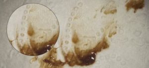 Коричневые выделения при беременности на 8 неделе