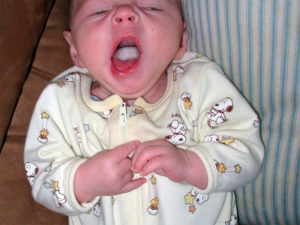 Молочница симптомы у детей во рту