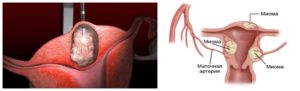 Симптомы миомы матки 8 9 недель
