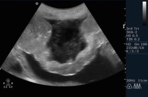 Отслойка плаценты 16 неделе беременности
