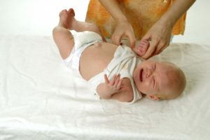 Как вылечить у новорожденного пупочную грыжу?