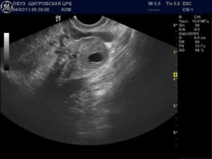 Киста желтого тела беременности 12 недель