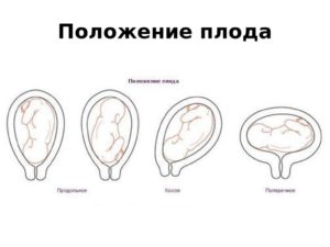 Поперечное положение плода 31 неделю