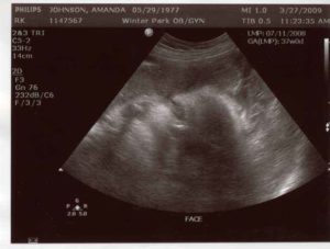 4 Недели беременности колит бок