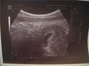 6 5 Эмбриональных недель 8 акушерская