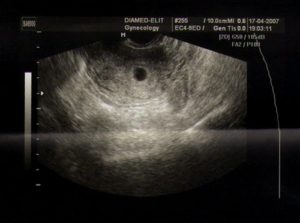 Орз 5 неделе беременности