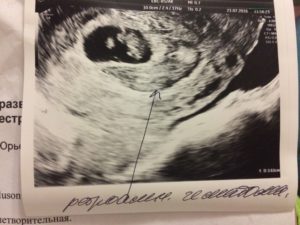 10 Неделя беременности отслойка