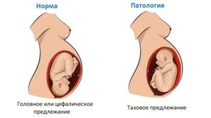 32 Неделя беременности расположение плода