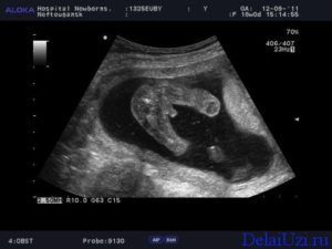 17 Недель беременности можно узнать пол ребенка
