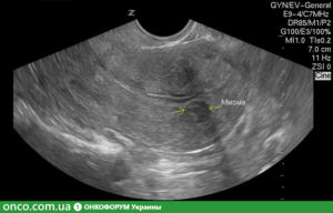 Миома матки 11 недель что делать