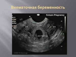 Внематочная беременность 11 недель