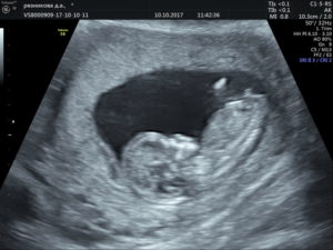 Первый скрининг 12 недель беременности