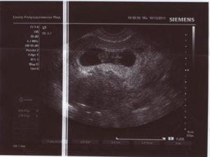 Третья беременность 17 недель шевелений