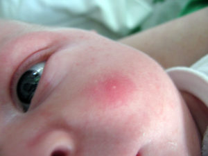 У новорожденного красные прыщи