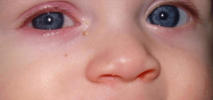 У ребенка 6 месяцев гноится глаз