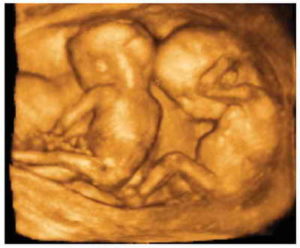 3d узи 14 недель