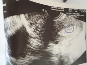 5 Недель беременности тянет правый яичник