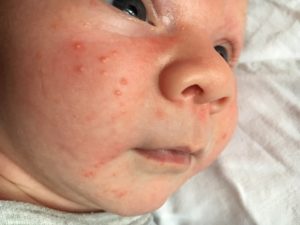 Прыщи у новорожденных на лице как лечить