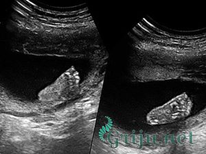 Болит тянет живот 11 недель