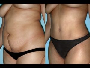 Дряблый живот после родов как убрать отзывы