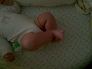 Гипертонус ребенку 5 месяцев