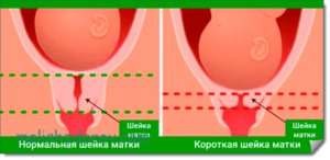 Короткая шейка матки при беременности 27 недель