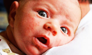 Чем лечить у новорожденного диатез
