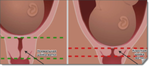 Короткая шейка матки беременности 23 недели