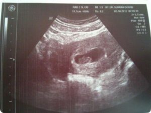 8 Недель узи 6