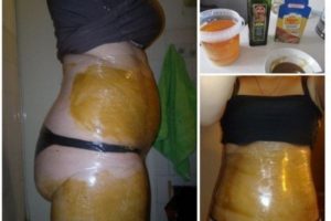 Как убрать живот с помощью медицины?