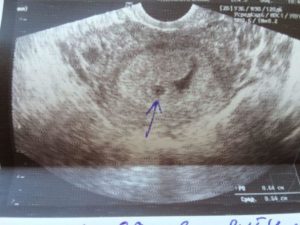 2 Недели беременности от зачатия признаки