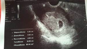 Угроза выкидыша 3 неделе беременности