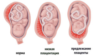 Низкая плацента при беременности 12 недель